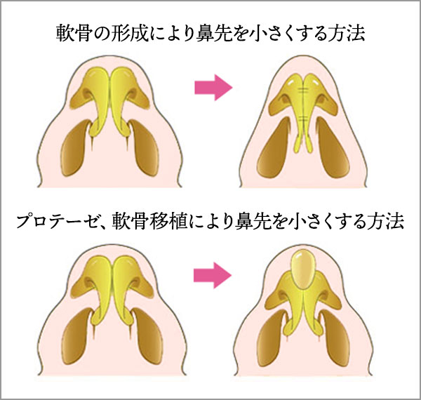 鼻尖縮小形成術