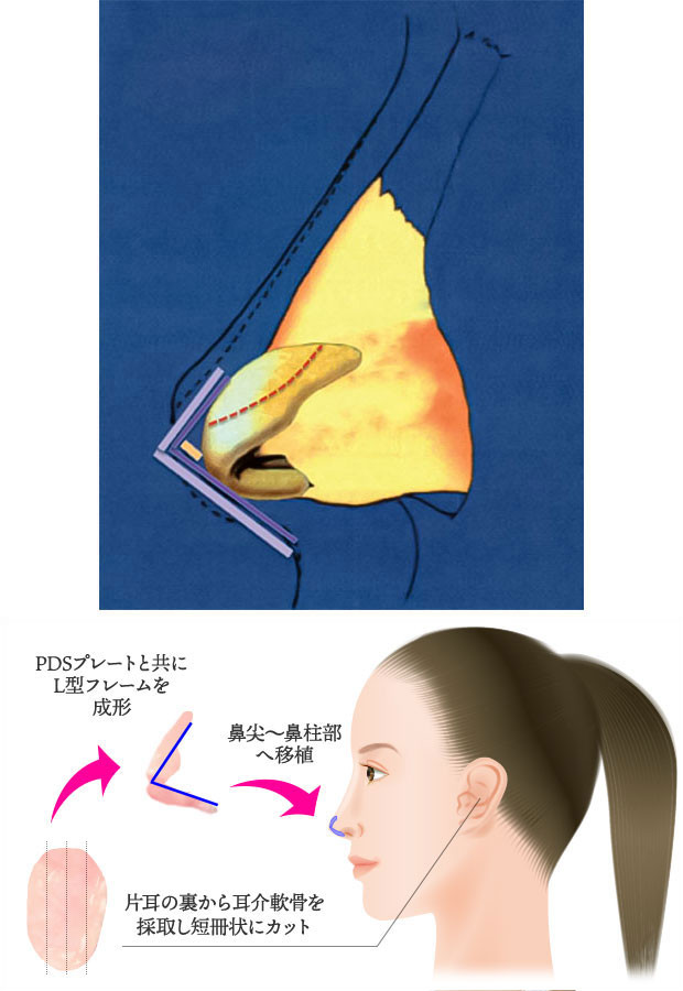 耳介軟骨L型フレームによる鼻尖形成
