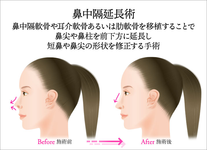 鼻中隔延長術