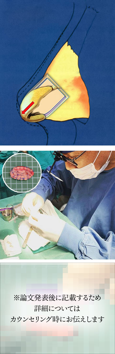 Box型移植軟骨フレームによる鼻中隔延長術