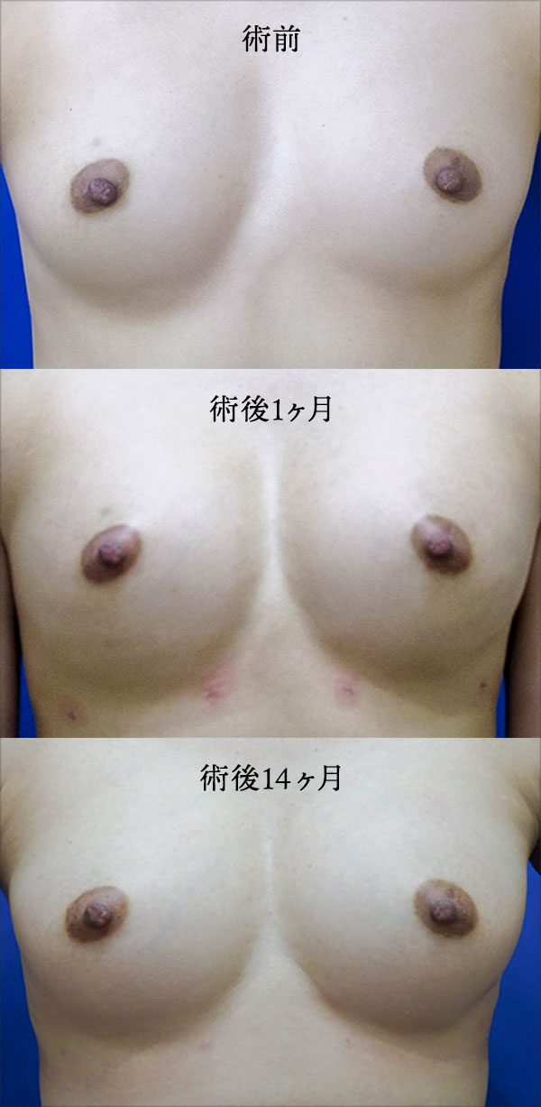 田中真輔式ピュアグラフト豊胸手術 症例写真