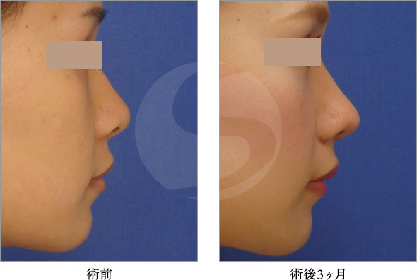 田中式鼻尖縮小形成術 症例写真