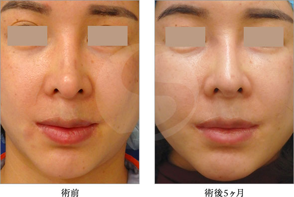 田中真輔式I型プロテーゼ挿入術 症例写真