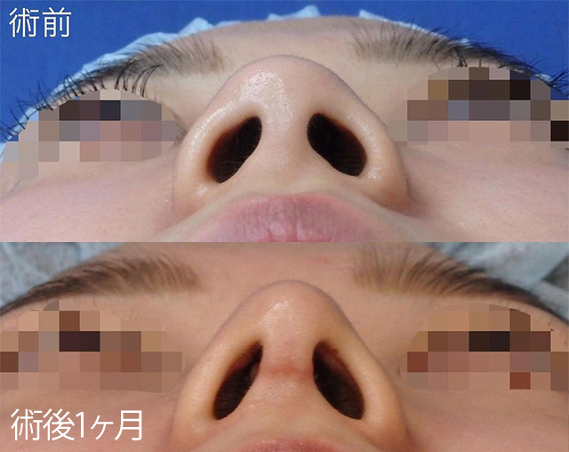 田中真輔式鼻中隔延長術 症例写真