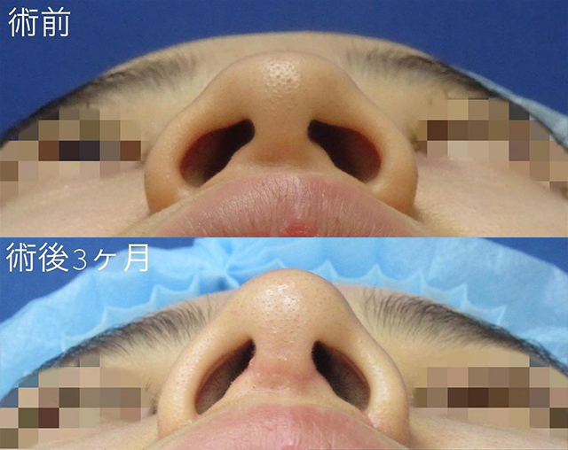 田中真輔式鼻尖縮小形成術 症例写真