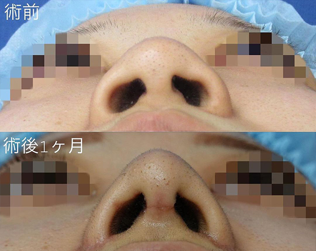田中真輔式鼻中隔延長術 症例写真