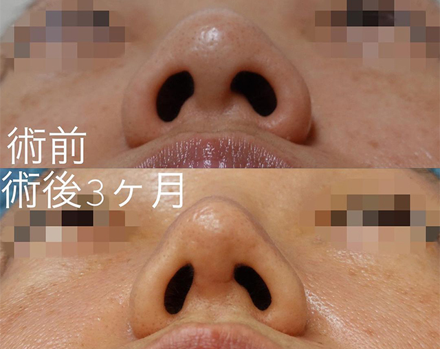 田中真輔式鼻尖縮小形成術 症例写真
