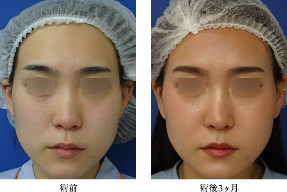 田中真輔式鼻尖縮小形成術 症例写真