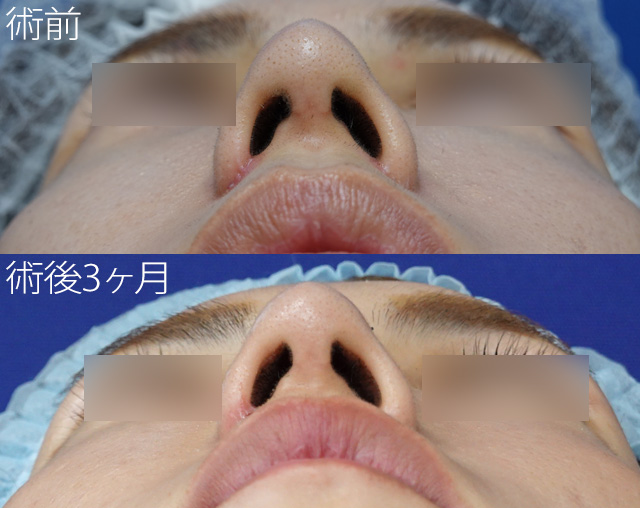 田中真輔式鼻尖縮小形成術 症例写真