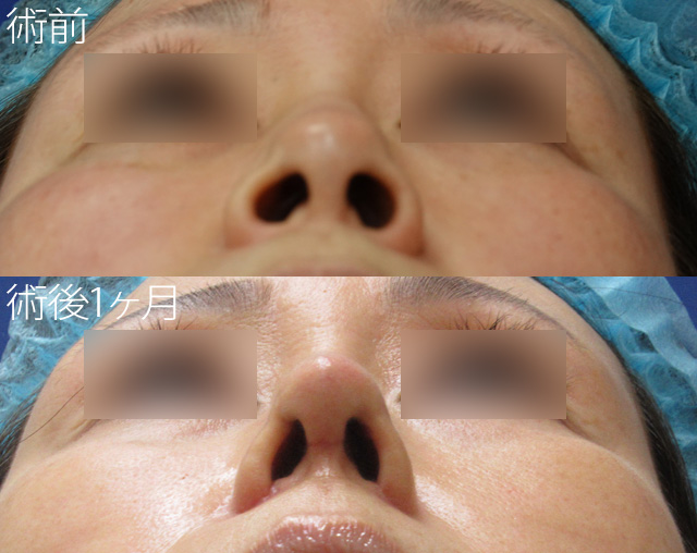 田中真輔式鼻中隔延長術 症例写真